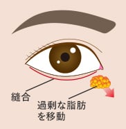 切開ハムラ(表ハムラ)傷跡 イメージ