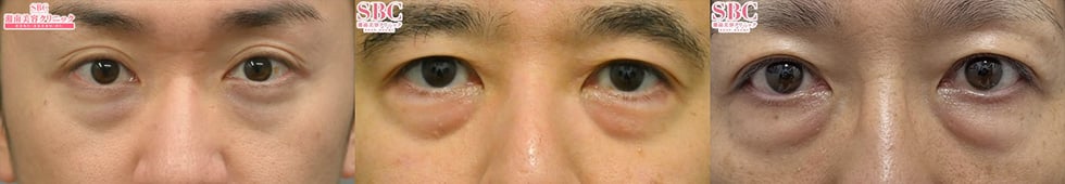 実年齢より老けて見える?そんな男性はクマ取りをオススメします!