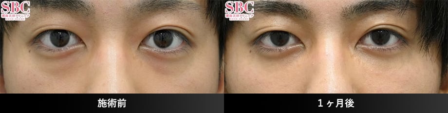 目の下の切らないクマ・たるみ(ふくらみ)取り20代症例写真