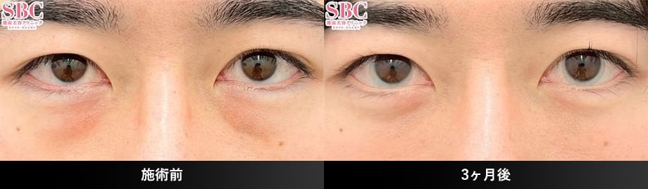 裏ハムラ20代症例写真