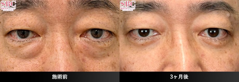 裏ハムラ40代症例写真