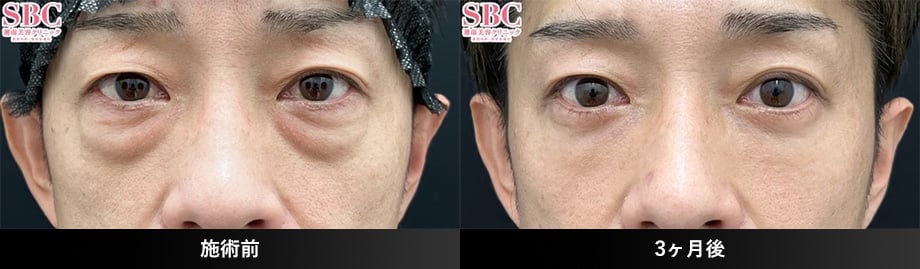 切開ハムラ(表ハムラ)40代症例写真