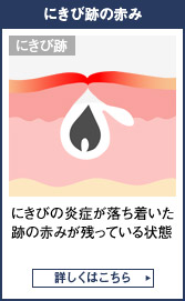 黒にきびとは 男性美容も湘南美容クリニック